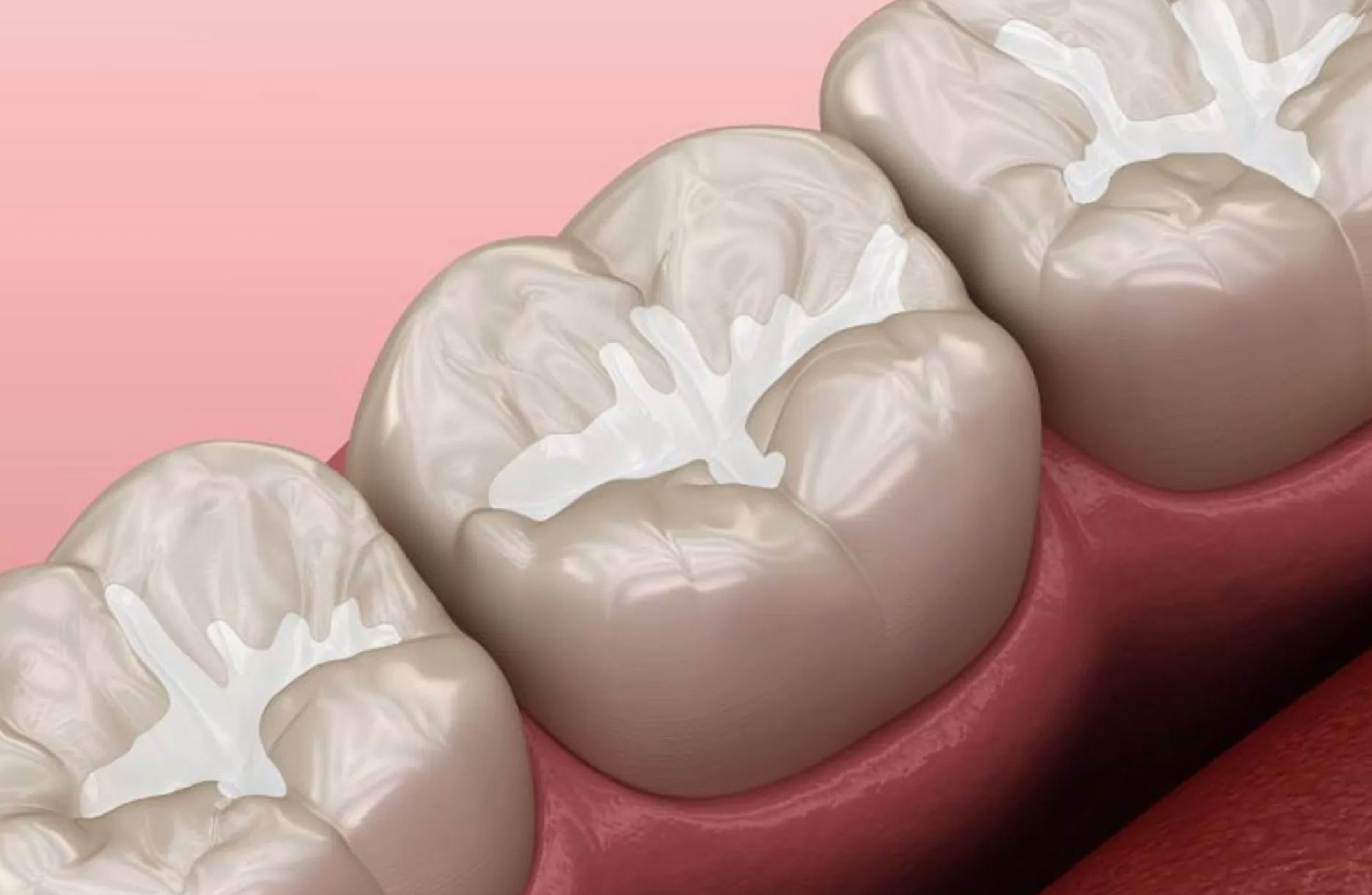 Keeping Little Smiles Healthy with Fissure Sealants