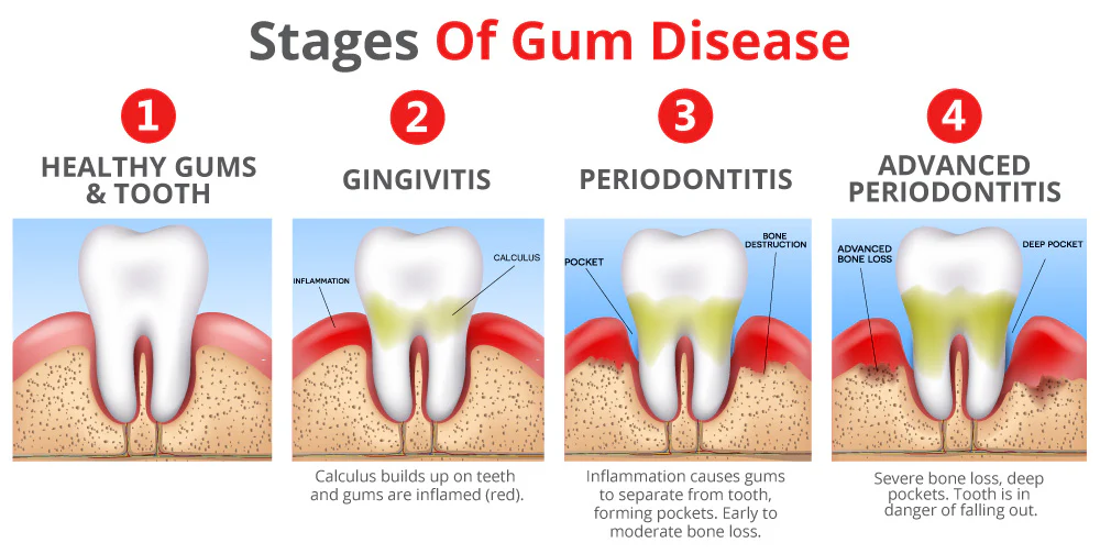 What Is Gum Disease?