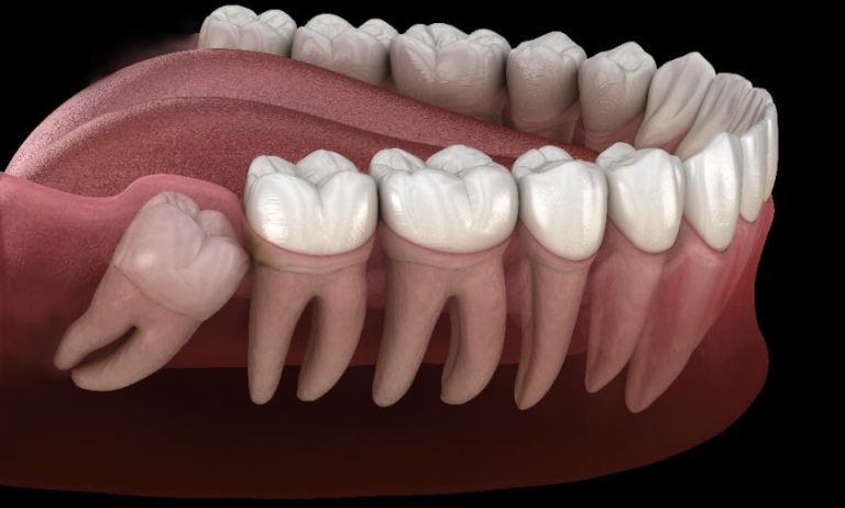 impacted wisdom tooth