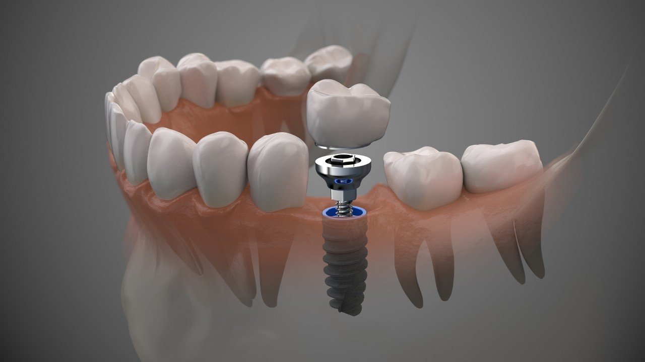 Dental Implants – Frankston